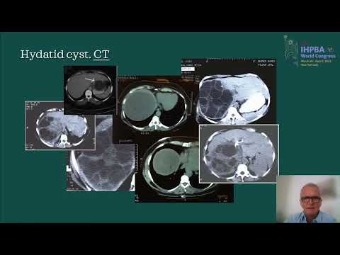US18: Timing for Surgical Management of Cystic Lesions in the Liver