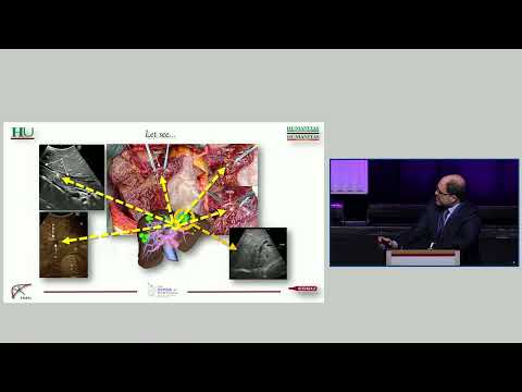 SYM01: Bilobar Colorectal Liver Metastasis