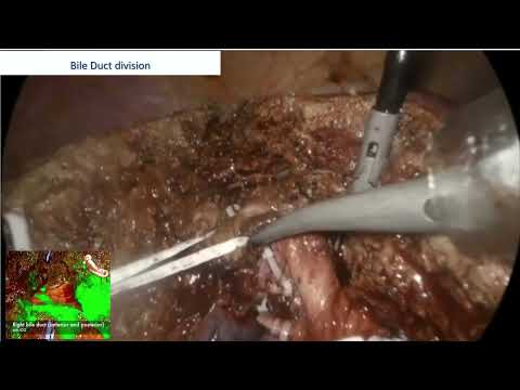 SYM18 IHPBA Meets ILLS MIS Major Hepatectomy