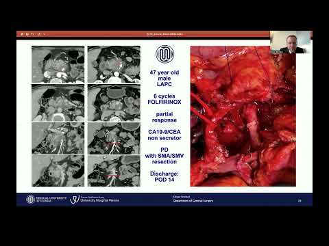 SYM22: Surgical Strategies for Pancreatic Cancer in the Neoadjuvant Era