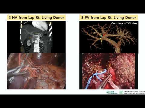 DEB16: Donor Hepatectomy Laparoscopic vs Open