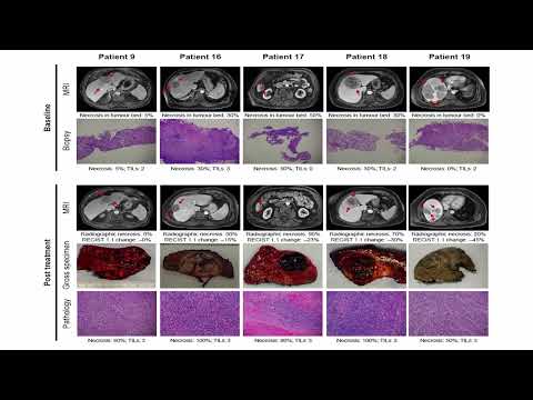 US07: Immune Checkpoint Inhibitors given before or after Transplant