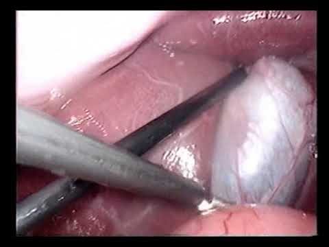 Prevention of Bile Duct Injuries