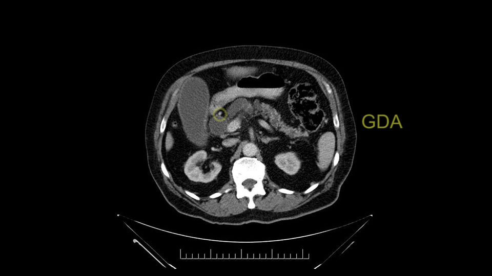 preOp_SS_momentPro5b